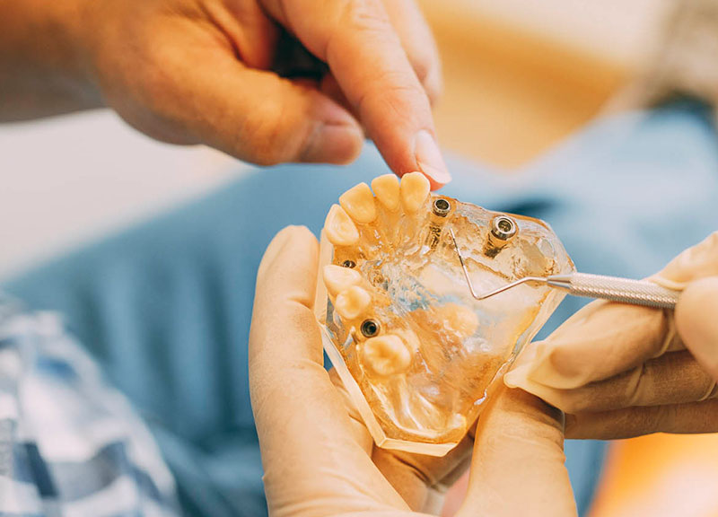 Zahnimplantate Leverkusen ersetzen fehlende Zähne nah am Original